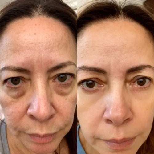 OcchiLumi® Terapia a Luce Rossa 2-in-1 + Balsamo Contorno Occhi